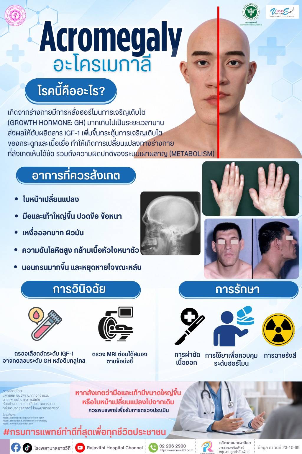 โรงพยาบาลราชวิถี ชวนรู้จักโรค Acromegaly ภาวะฮอร์โมนการเจริญเติบโตสูงผิดปกติ  สังเกตอาการให้ทันก่อนเกิดภาวะแทรกซ้อน